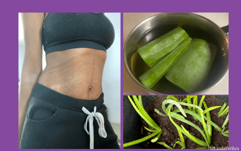 stretchmarks stomach and aloe vera gel